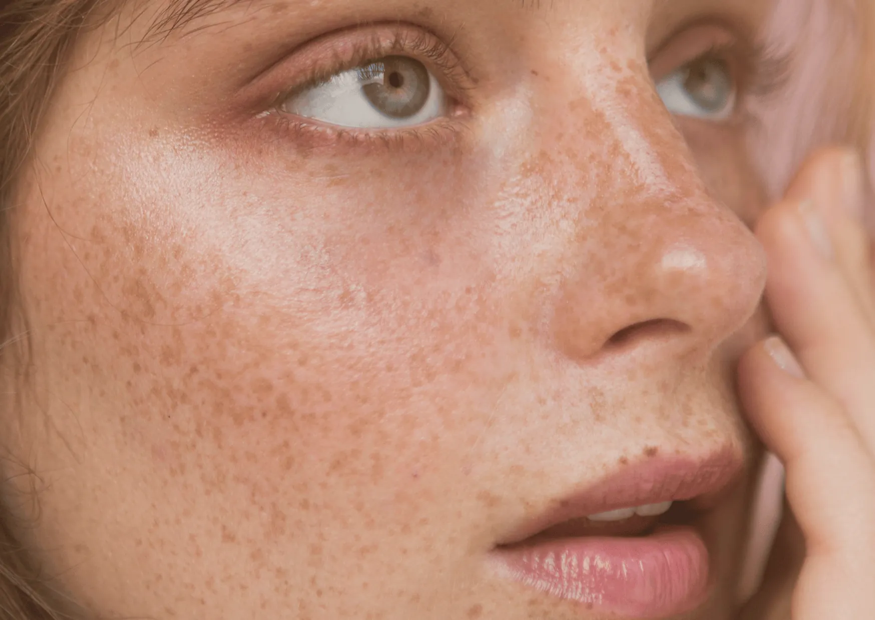 Skin Pigmentation