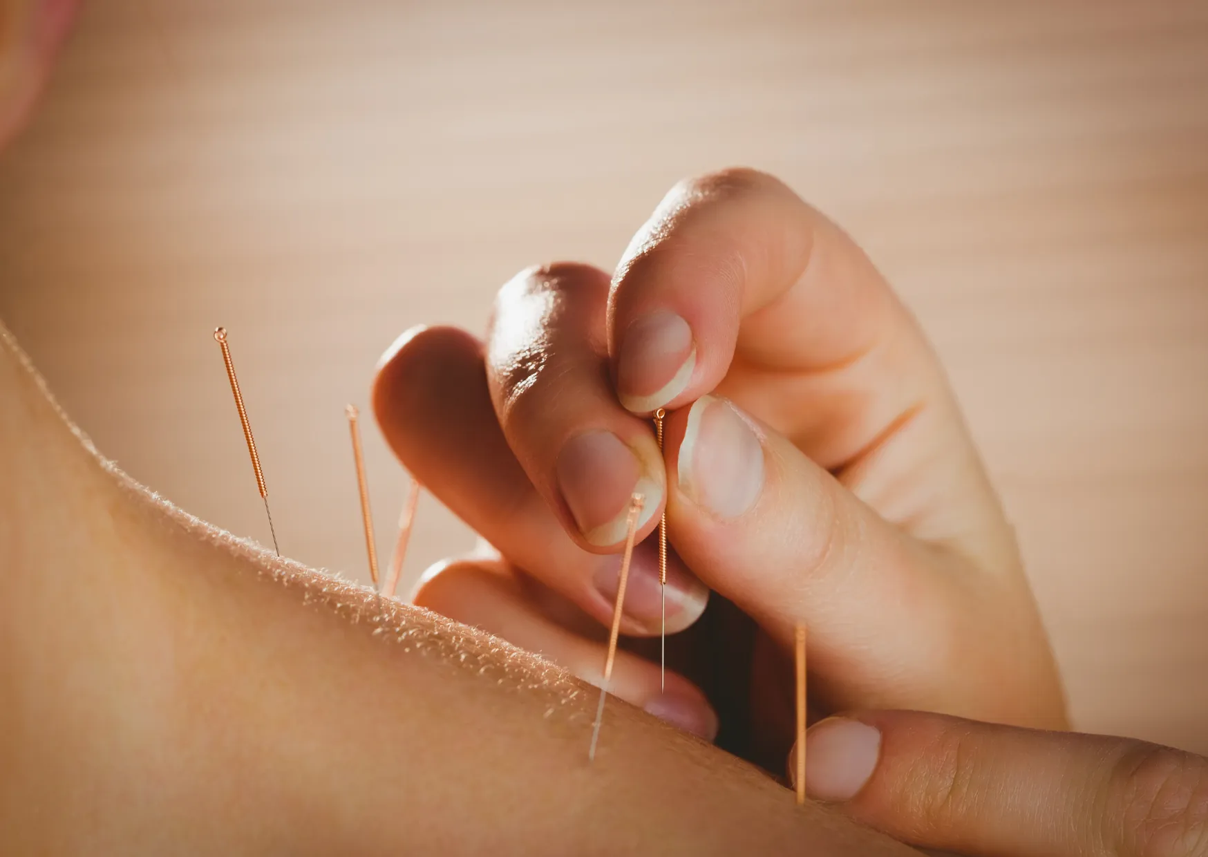 Acupuncture