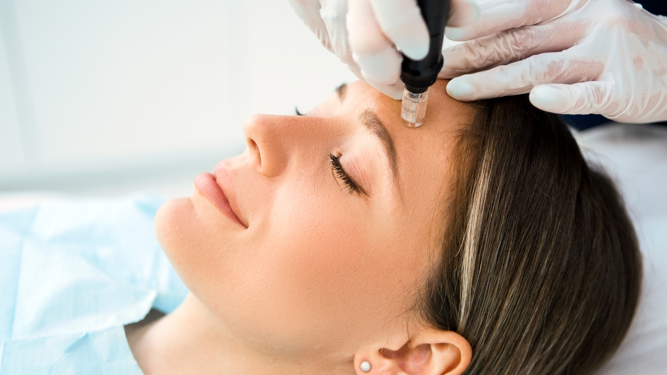 Mesotherapy for summer glow