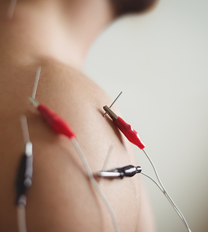 Electro Acupuncture