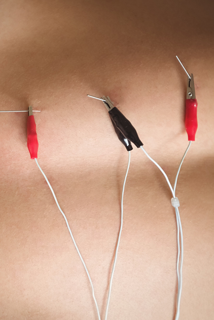 Electro Acupuncture 