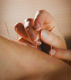 Acupuncture (45min / 60min)