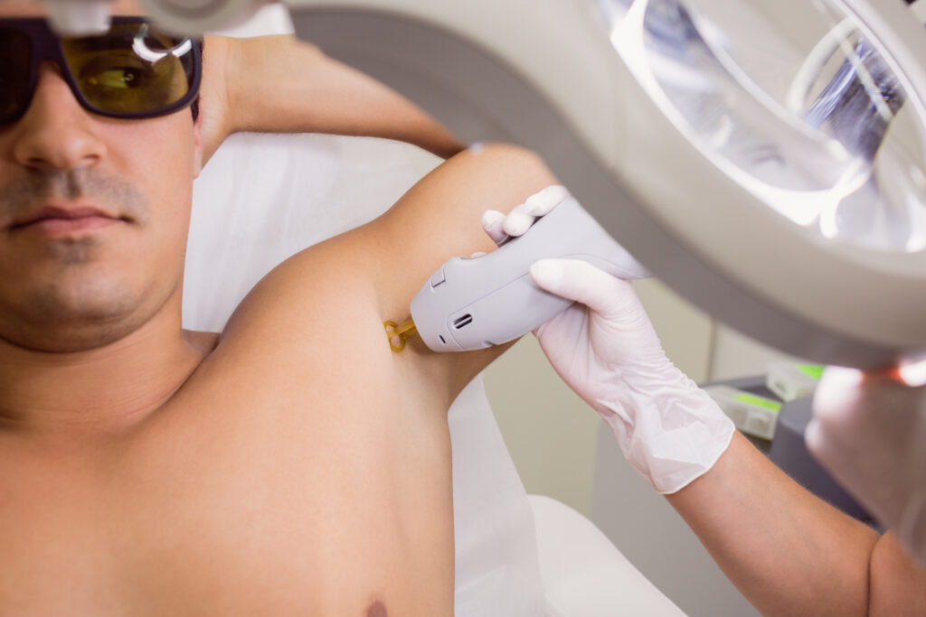 Benefits of laser hair removal